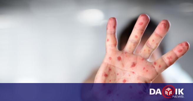 Бум на варицела и грип в Старозагорско (ВИДЕО)